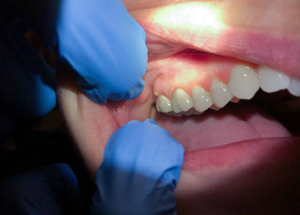 Best Emergency Dental Care for Sports Injuries in South Uniontown, PA